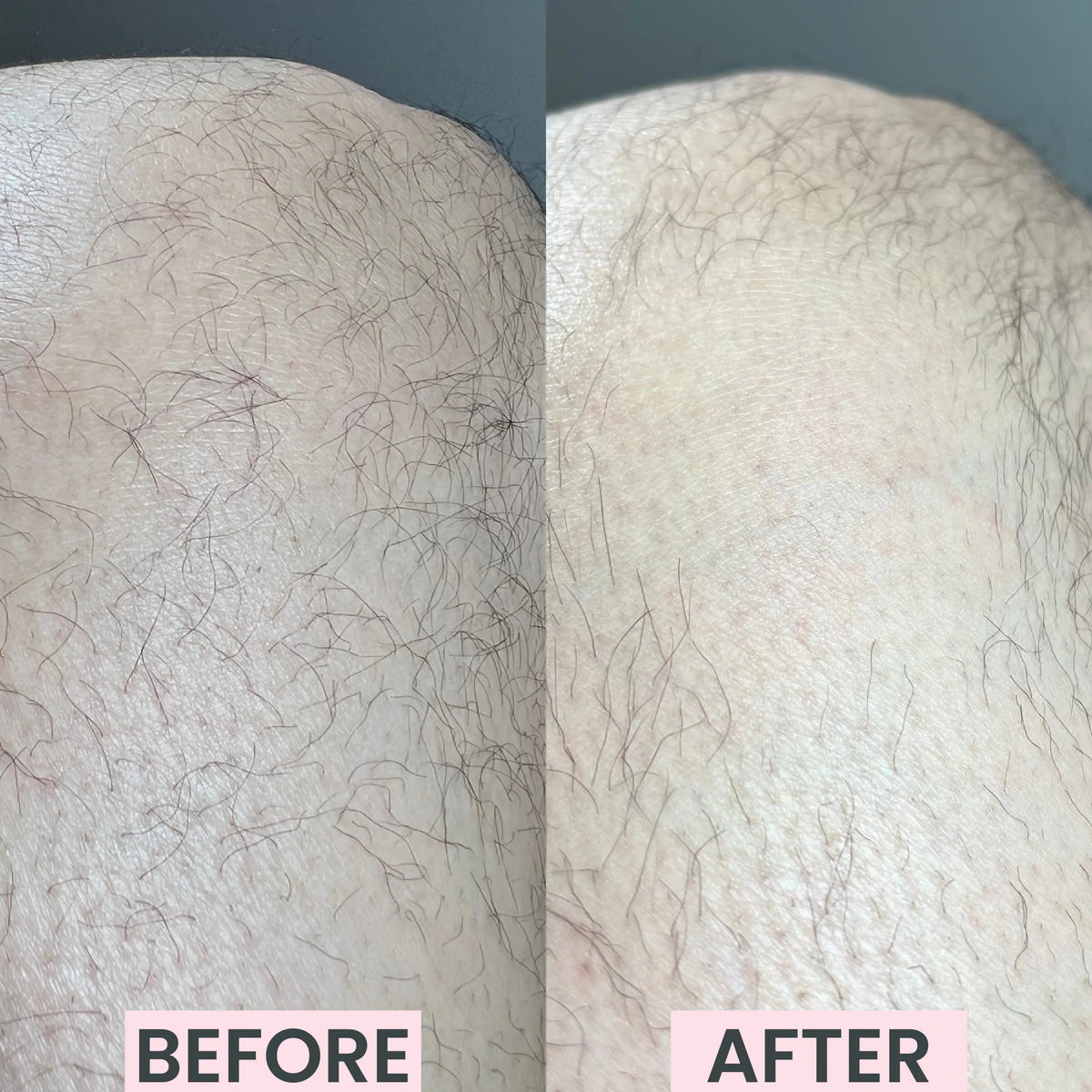 Silkly - Crystal Hair Remover