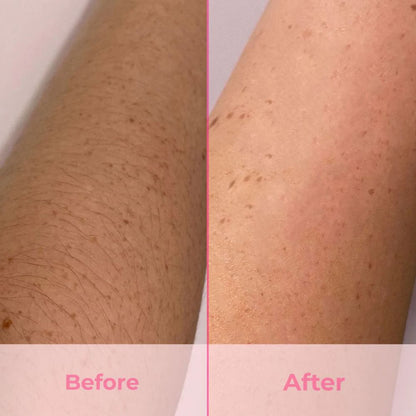 IPL Hair Removal